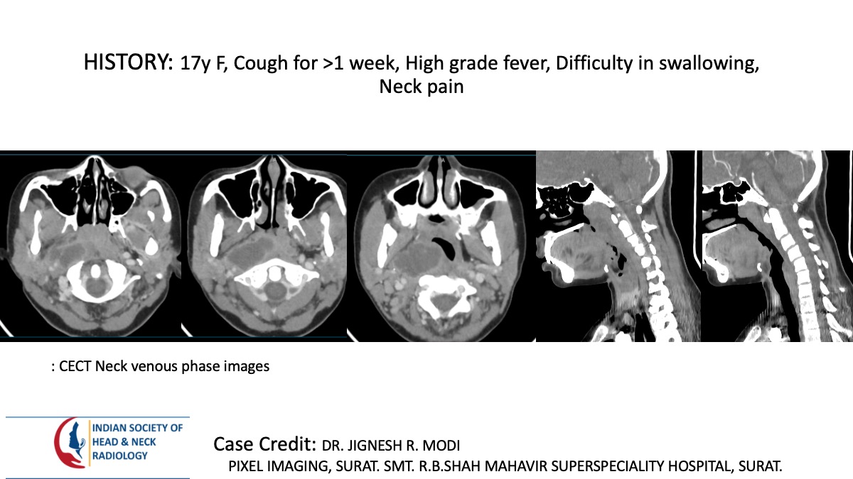 Case 153