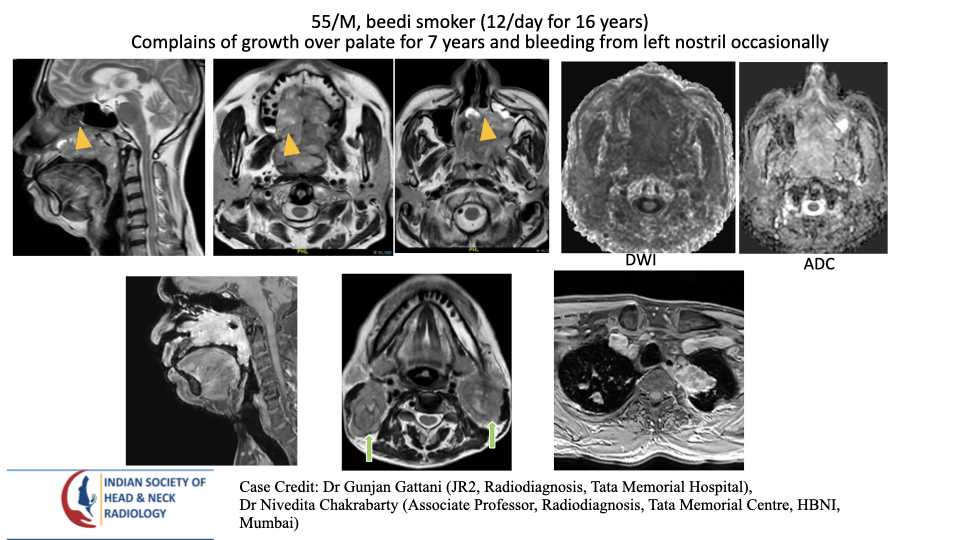 Case 185 — slide 1 of 3